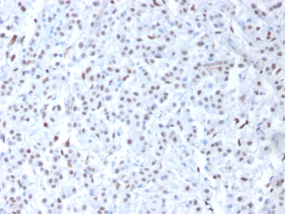 FFPE human mesothelioma sections stained with 100 ul anti-Wilms Tumor 1 (clone 6F-H2) at 1:200. HIER epitope retrieval prior to staining was performed in 10mM Citrate, pH 6.0.